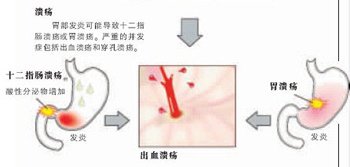 胃溃疡的危害知多少
