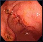 急性肠炎的特点与临床症状