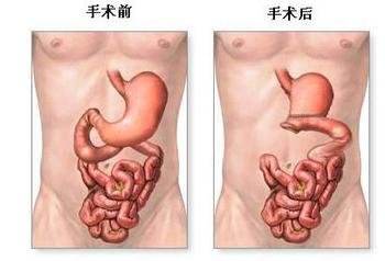 不同类型的急性肠炎应该如何治疗