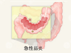 急性肠炎是怎么引起的?